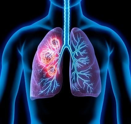 Precision Medicine